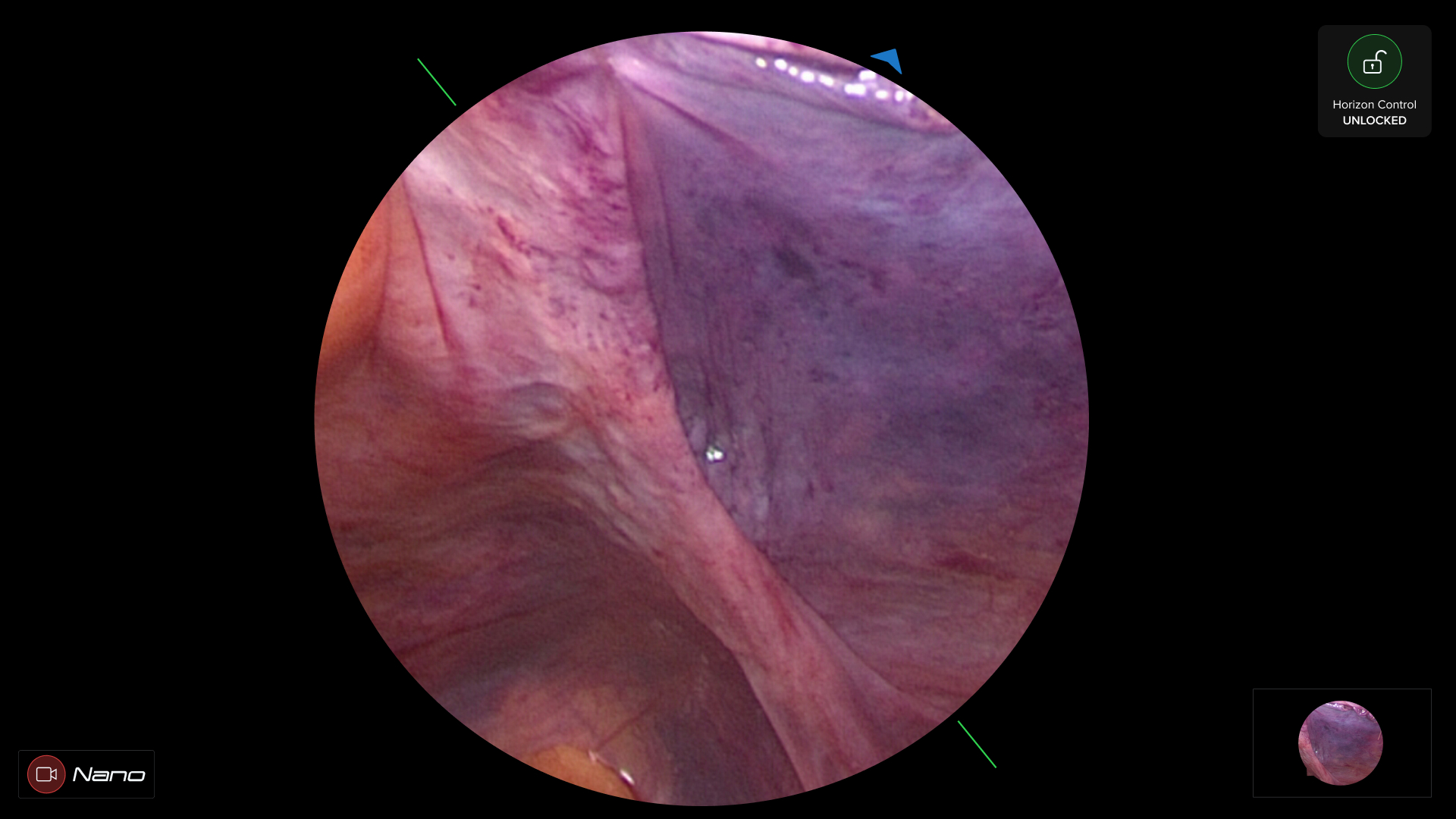 Arthroscopy Embedded Medical Software